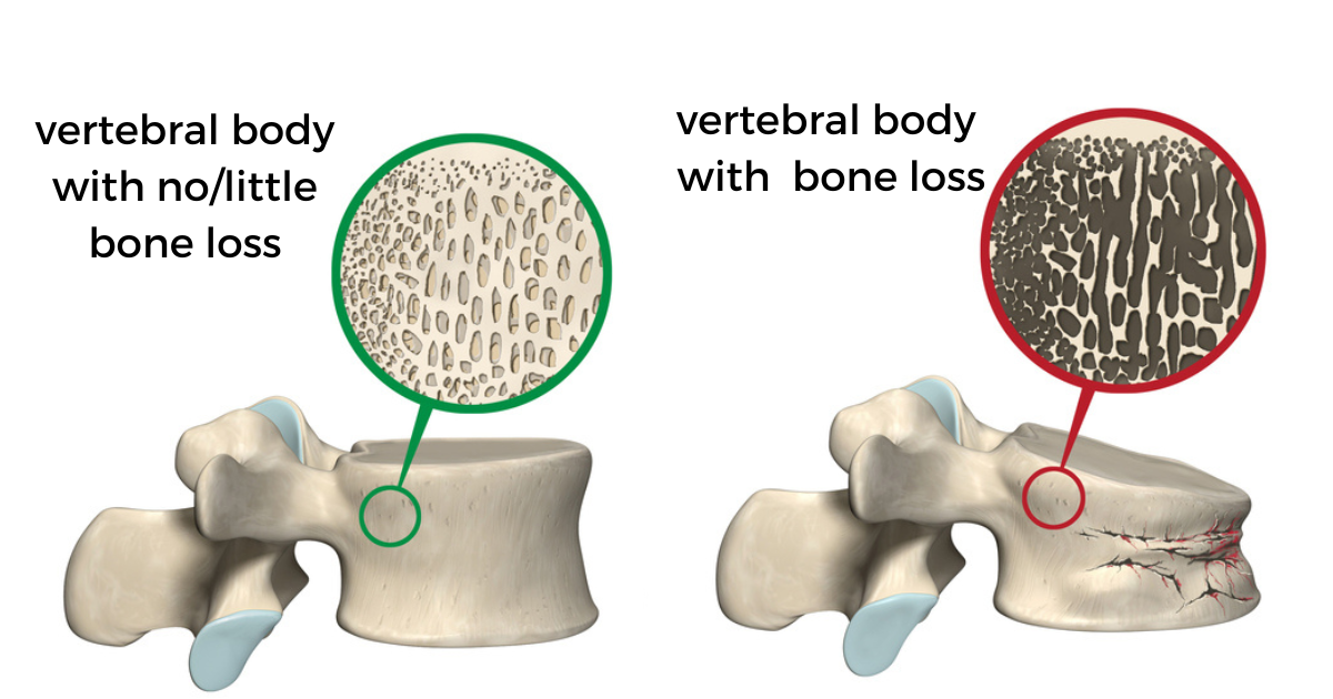 weight bearing exercises for osteoporosis Fitstreams Club