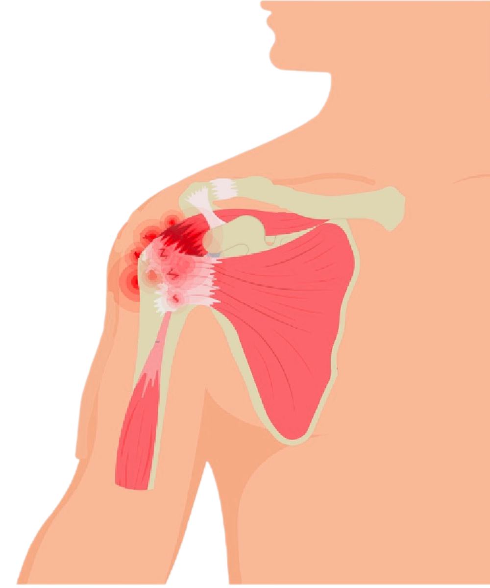 Torn Rotator Cuff Diagram